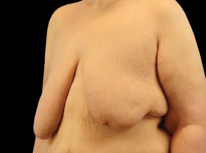 Female To Male Breast Before & After Patient #3966