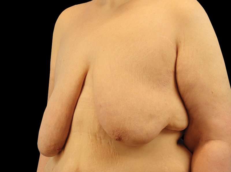 Female To Male Breast Before & After Patient #3966