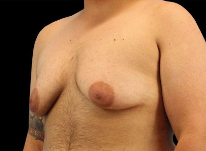 Female To Male Breast Before & After Patient #3977