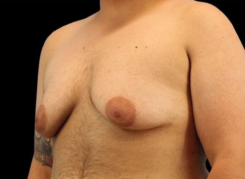 Female To Male Breast Before & After Patient #3977