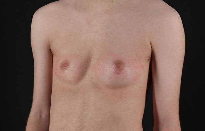 Female To Male Breast Before & After Patient #4031