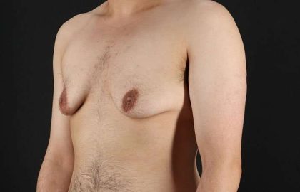 Female To Male Breast Before & After Patient #4042