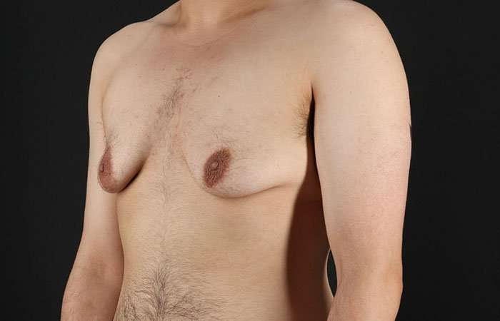 Female To Male Breast Before & After Patient #4042