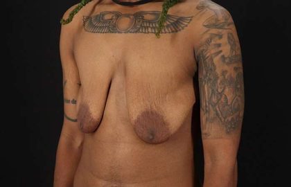 Female To Male Breast Before & After Patient #4053
