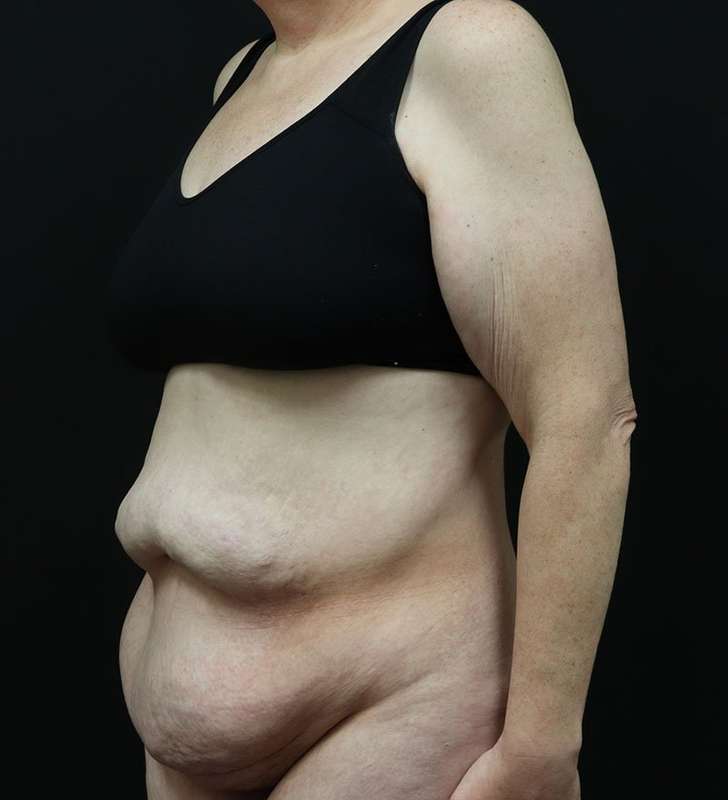 Abdominoplasty (Tummy Tuck) Before & After Patient #948