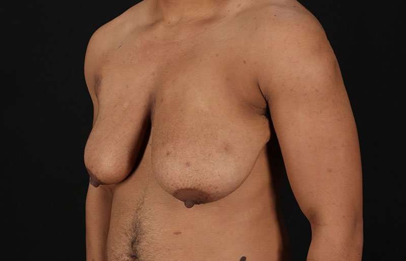Female To Male Breast Before & After Patient #4086
