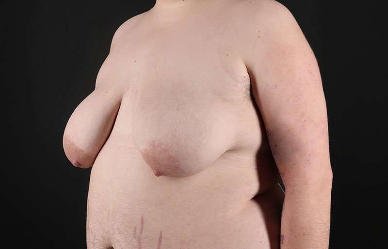 Female To Male Breast Before & After Patient #4097
