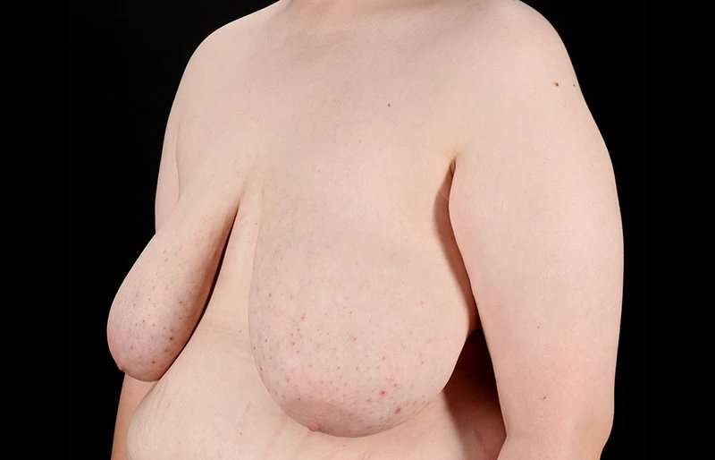 Female To Male Breast Before & After Patient #4130