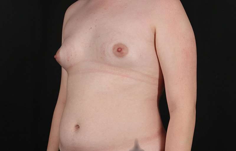 Female To Male Breast Before & After Patient #4163