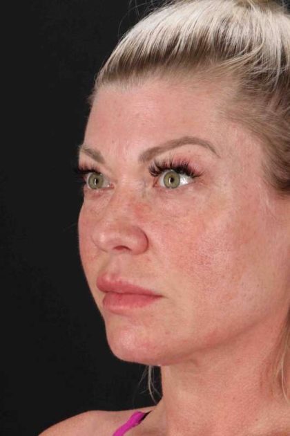 Fat Grafting To The Face Before & After Patient #4232