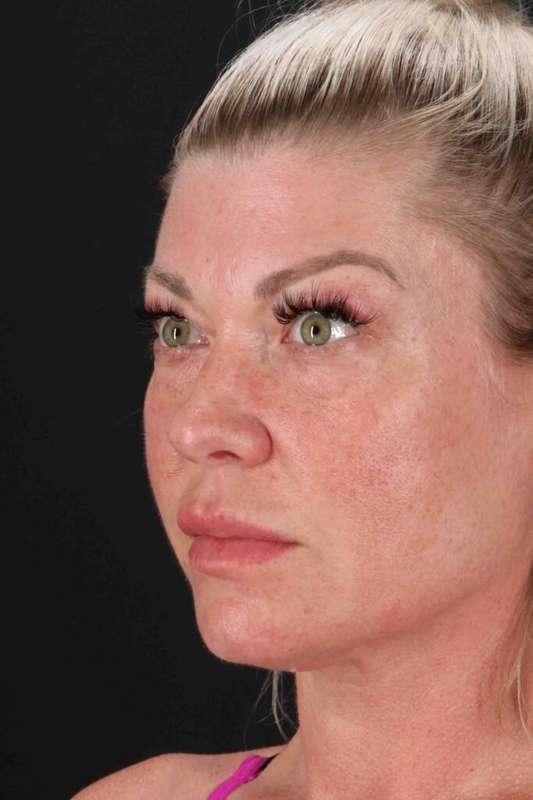 Fat Grafting To The Face Before & After Patient #4232