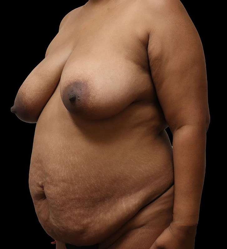 Abdominoplasty (Tummy Tuck) Before & After Patient #975