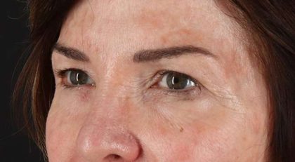 Blepharoplasty (Eyelid Surgery) Before & After Patient #4316