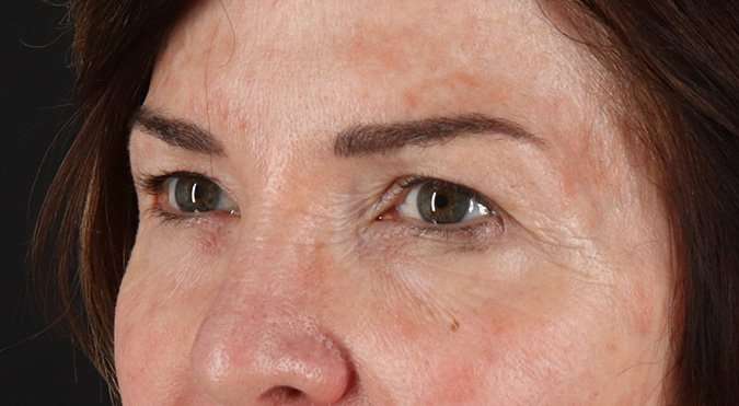 Blepharoplasty (Eyelid Surgery) Before & After Patient #4316