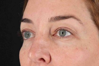 Blepharoplasty (Eyelid Surgery) Before & After Patient #4338