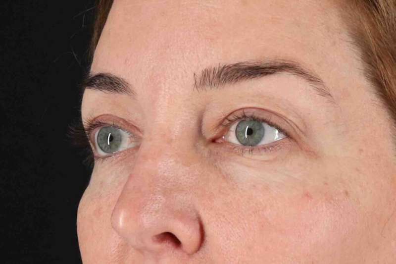 Blepharoplasty (Eyelid Surgery) Before & After Patient #4338
