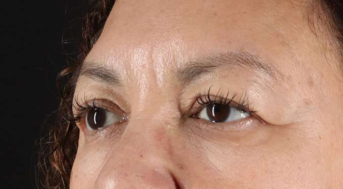 Blepharoplasty (Eyelid Surgery) Before & After Patient #4349