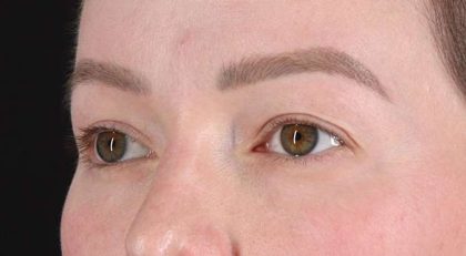 Blepharoplasty (Eyelid Surgery) Before & After Patient #4360
