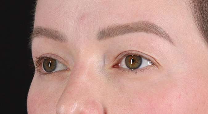 Blepharoplasty (Eyelid Surgery) Before & After Patient #4360