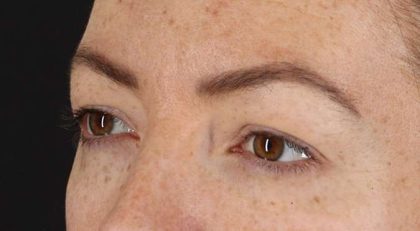 Blepharoplasty (Eyelid Surgery) Before & After Patient #4371