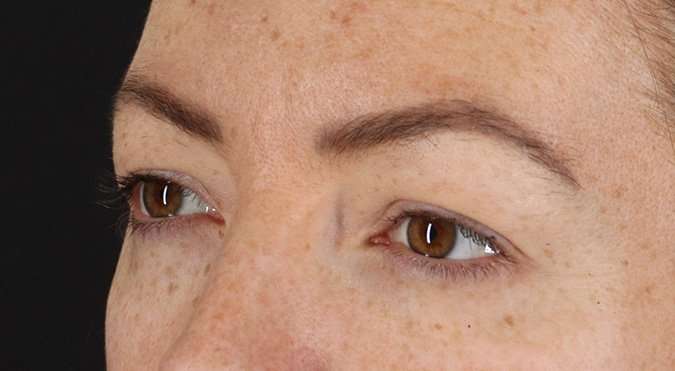 Blepharoplasty (Eyelid Surgery) Before & After Patient #4371