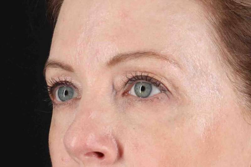 Blepharoplasty (Eyelid Surgery) Before & After Patient #4382