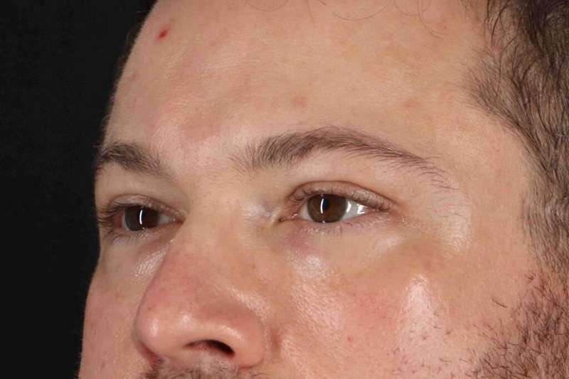 Blepharoplasty (Eyelid Surgery) Before & After Patient #4393