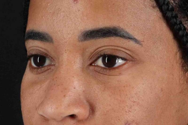 Blepharoplasty (Eyelid Surgery) Before & After Patient #4404
