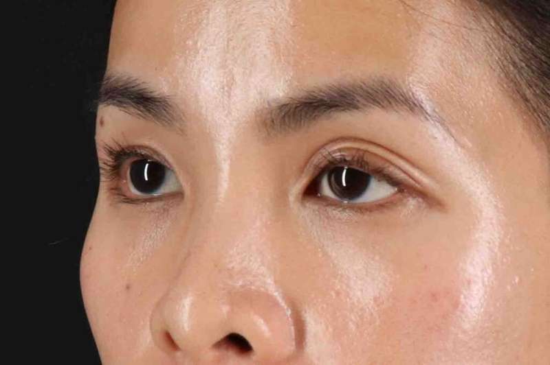 Blepharoplasty (Eyelid Surgery) Before & After Patient #4415