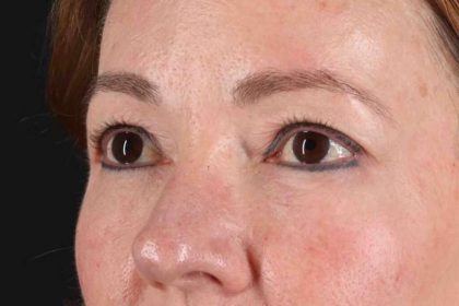 Blepharoplasty (Eyelid Surgery) Before & After Patient #4426