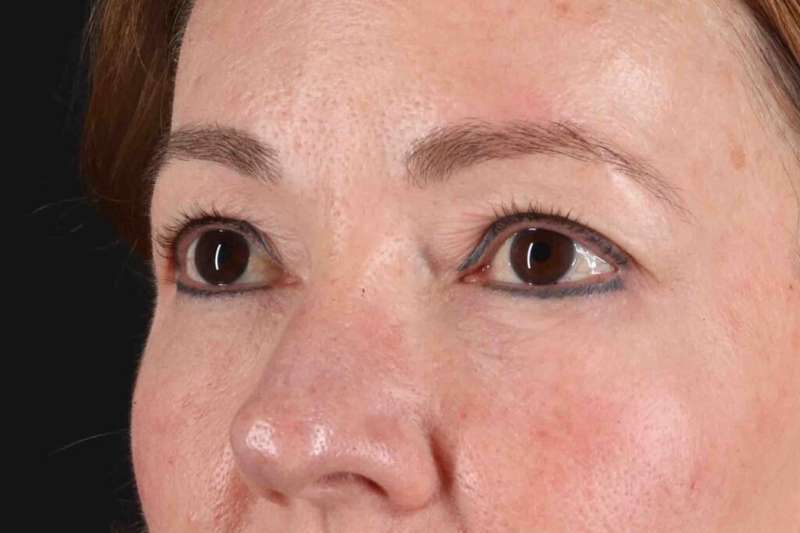Blepharoplasty (Eyelid Surgery) Before & After Patient #4426