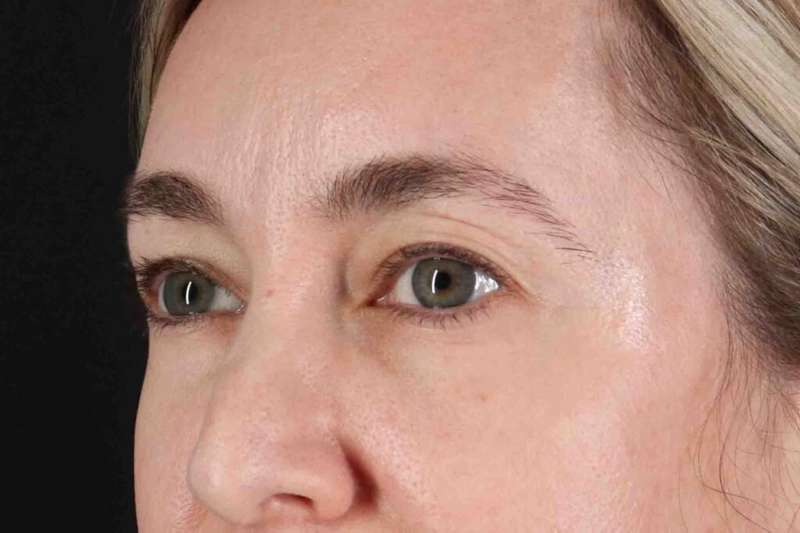Blepharoplasty (Eyelid Surgery) Before & After Patient #4437