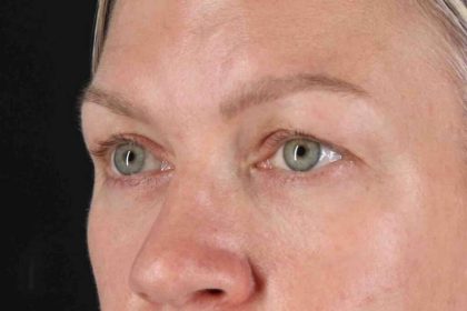 Blepharoplasty (Eyelid Surgery) Before & After Patient #4448