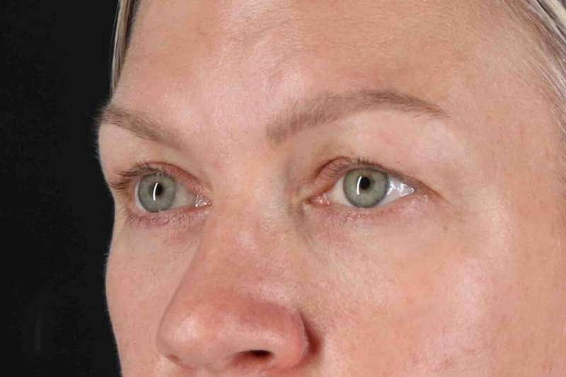 Blepharoplasty (Eyelid Surgery) Before & After Patient #4448