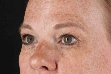 Blepharoplasty (Eyelid Surgery) Before & After Patient #4459