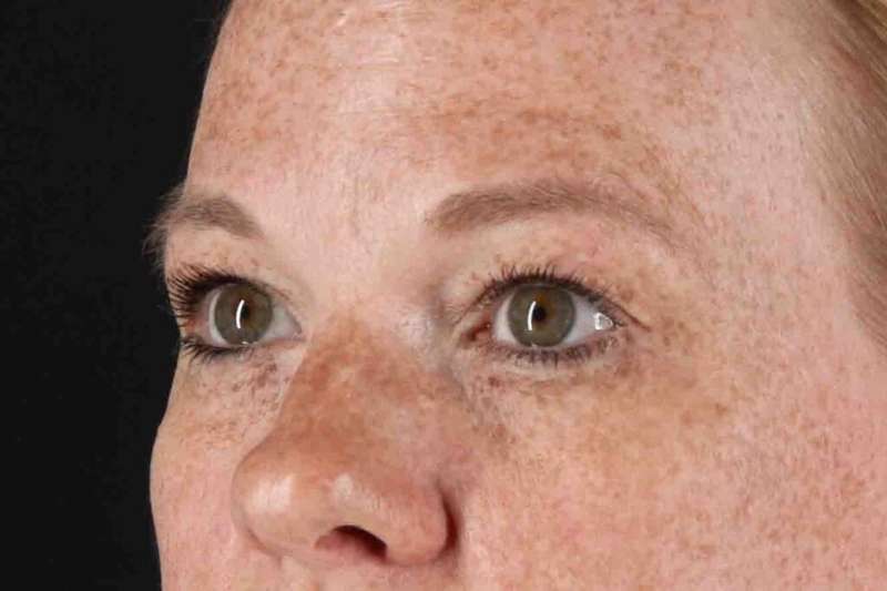 Blepharoplasty (Eyelid Surgery) Before & After Patient #4459
