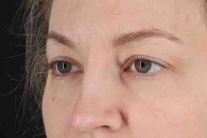 Blepharoplasty (Eyelid Surgery) Before & After Patient #4470