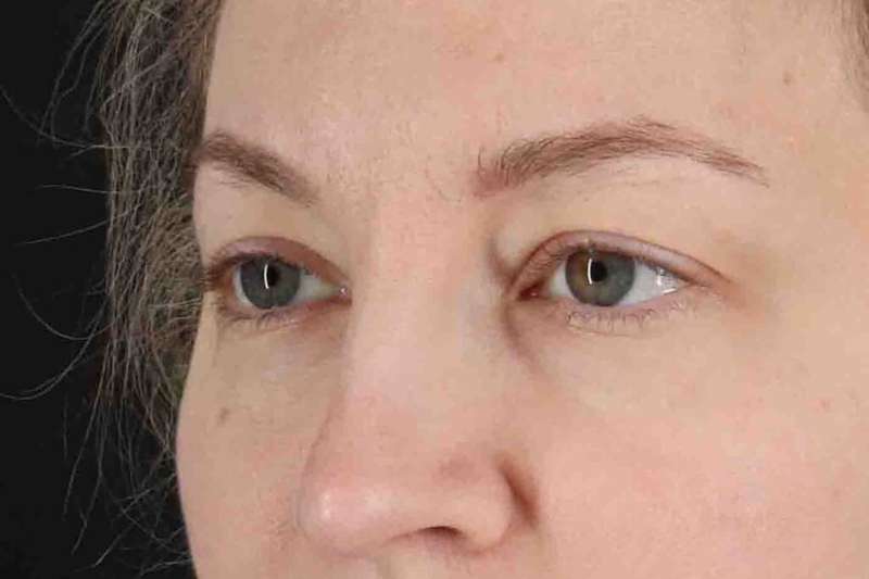 Blepharoplasty (Eyelid Surgery) Before & After Patient #4470