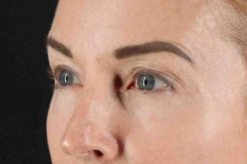 Blepharoplasty (Eyelid Surgery) Before & After Patient #4481