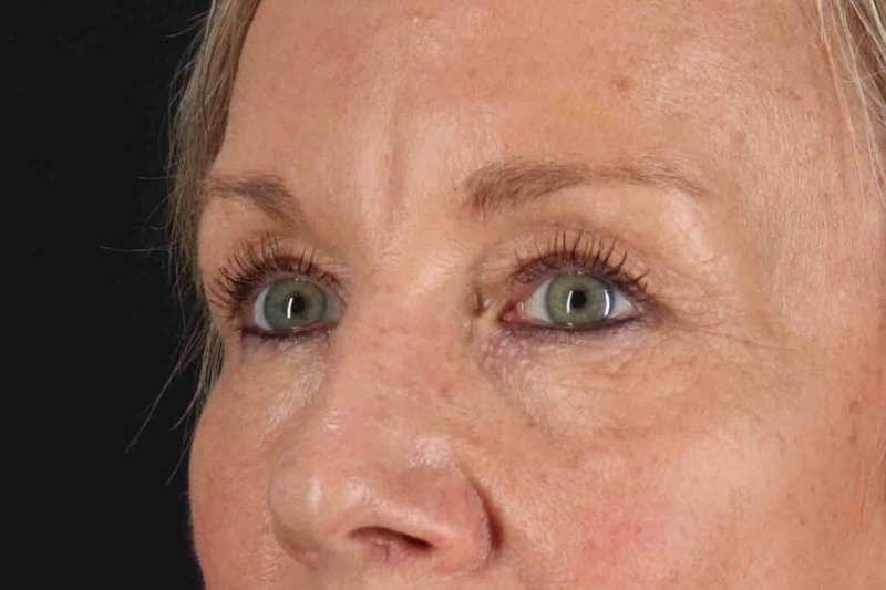 Blepharoplasty (Eyelid Surgery) Before & After Patient #4492