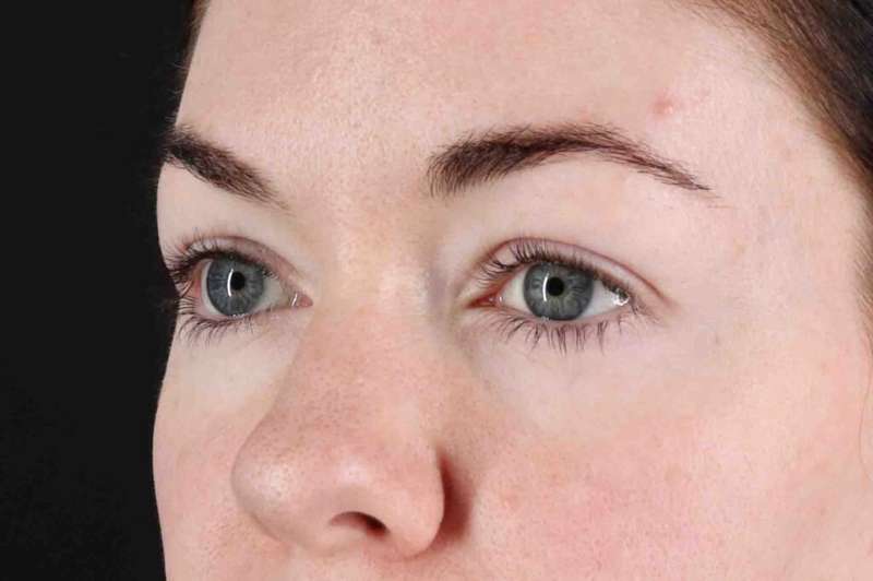 Blepharoplasty (Eyelid Surgery) Before & After Patient #4503