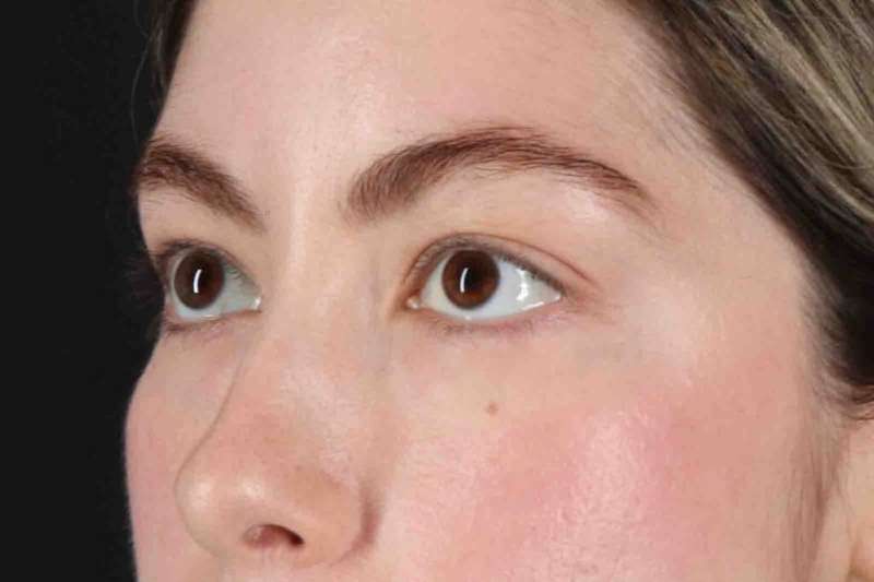 Blepharoplasty (Eyelid Surgery) Before & After Patient #4514