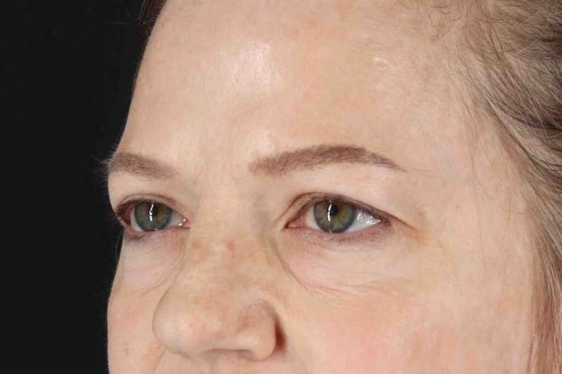 Blepharoplasty (Eyelid Surgery) Before & After Patient #4525