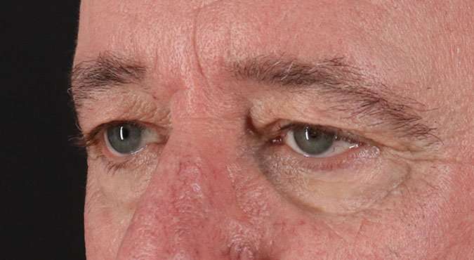 Blepharoplasty (Eyelid Surgery) Before & After Patient #4599