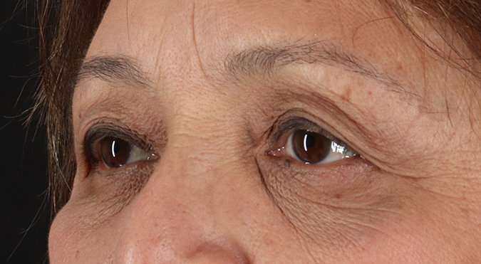 Blepharoplasty (Eyelid Surgery) Before & After Patient #4649