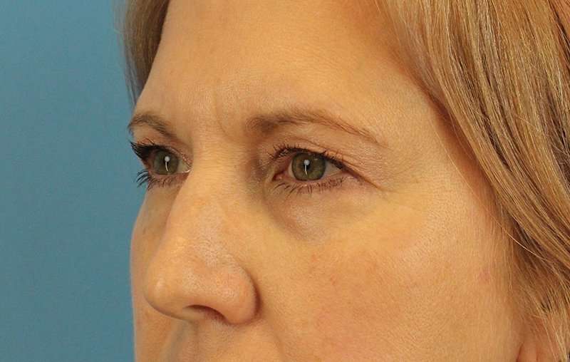Brow Lift Before & After Patient #4672