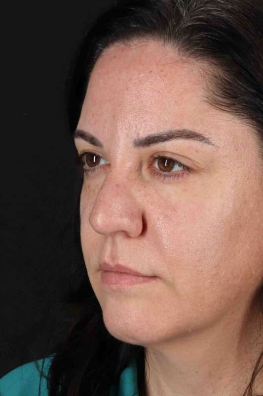 Brow Lift Before & After Patient #4733