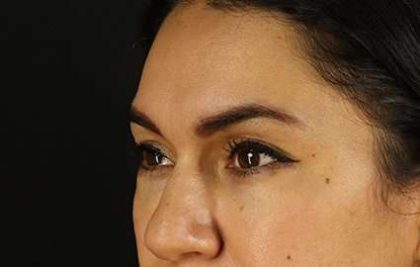 Brow Lift Before & After Patient #4744
