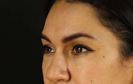 Brow Lift Before & After Patient #4744