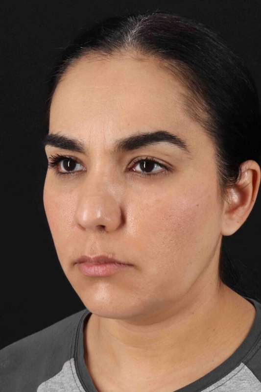 Brow Lift Before & After Patient #4755